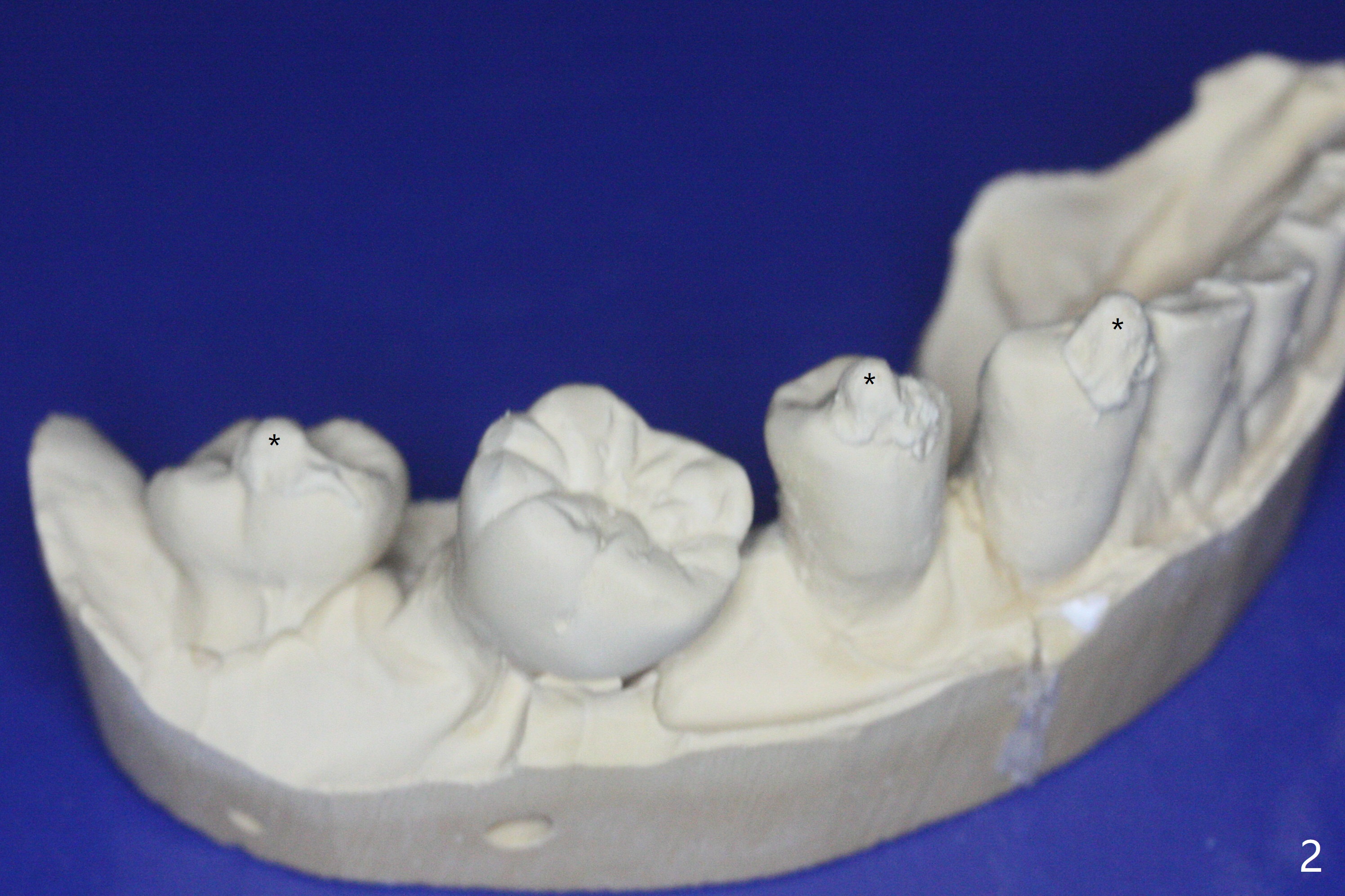 Composite Marker for Guided Immediate and Delayed Implants When the